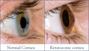 Normal Cornea (left) vs Keratoconic Cornea (right)